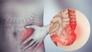 Irritable Bowel Syndrome or IBS